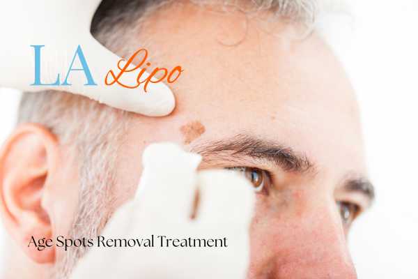 What Are the Most Effective Treatments for Age Spots Cottenham Park?