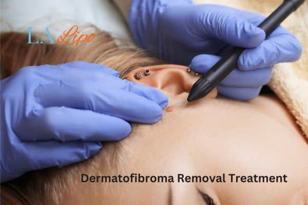 Dermatofibroma Removal Treatment Cottenham Park