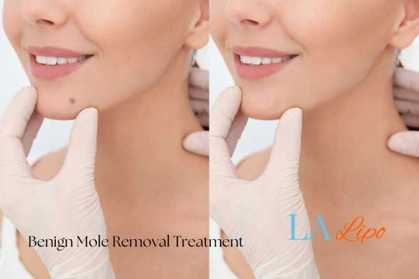 Before-and-after results following benign mole-removal treatment Cottenham Park