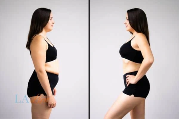 image of woman before and after results of LA-EMS Body Sculpting Cottenham Park to help treat Diastasis recti