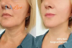 hi-fu for wrinkles Cottenham Park before and after results