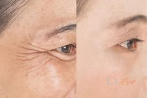 Before and after results of woman - HI-fu wrinkles reduction treatment Cottenham Park
