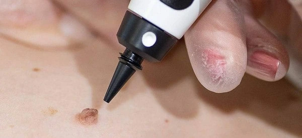 skin tag removal using cryopen Cottenham Park