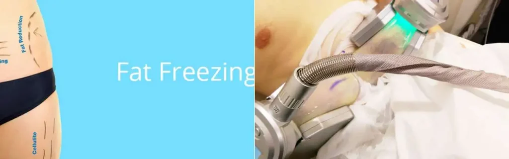 Fat freezing Cottenham Park on multiple areas of the body