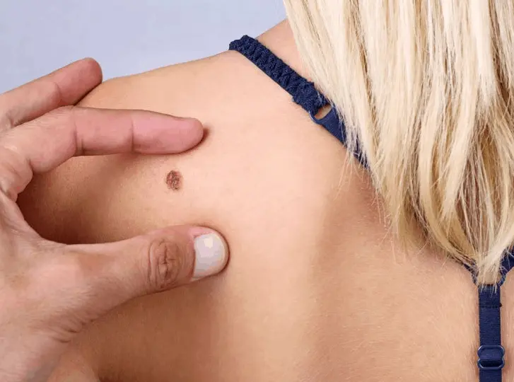 woman having mole removal Cottenham Park consultation before treatment.