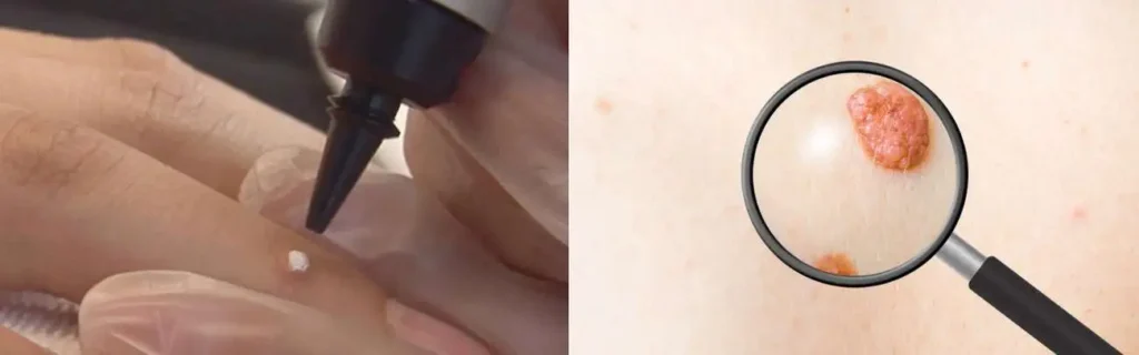 Cryopen for mole removal Cottenham Park - speak to our team today!