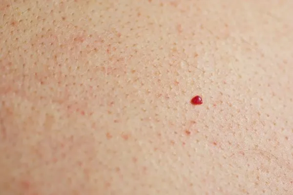 close up of a cherry angioma Cottenham Park