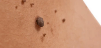 image of a skin tag Cottenham Park