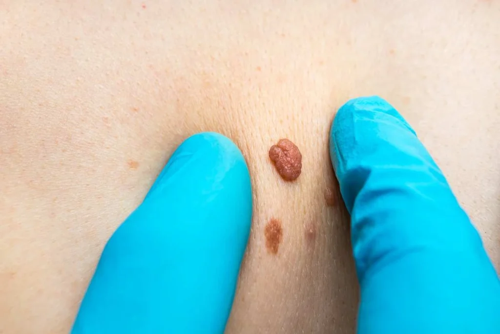 Consultant examining a skin tag Cottenham Park