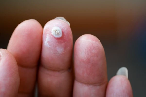 wart on person finger - cryotherapy to treat from LA LIPO Cottenham Park