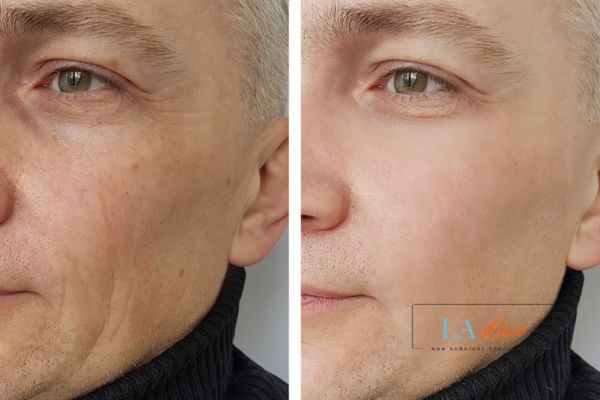 See the amazing results of Morpheus8 Treatment Cottenham Park!
