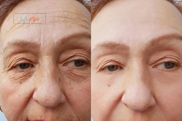 The powerful benefits of Morpheus8 Treatment Cottenham Park - Call Our team today!
