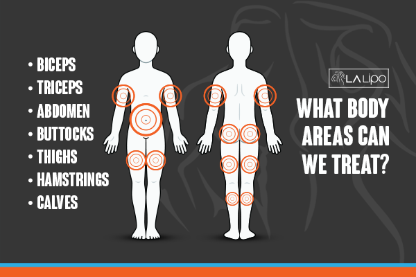Diagram to show areas you can have LA-EMS Body Sculpting Treatment Cottenham Park