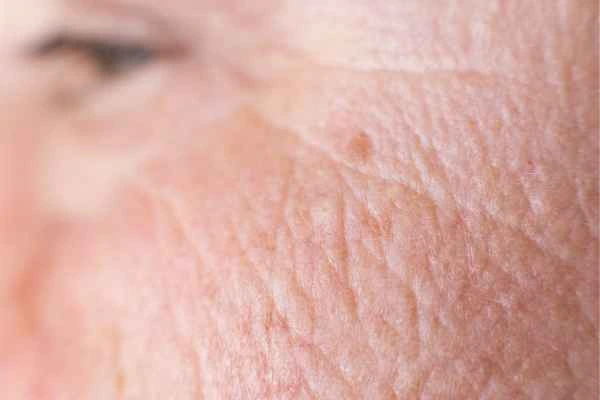 close up picture of a woman's face showing an age spot Cottenham Park