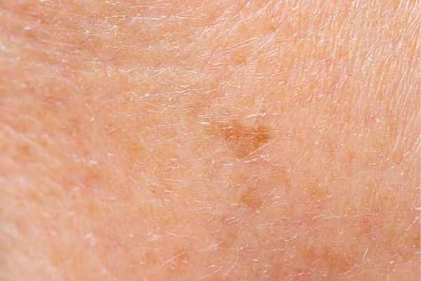 close up picture of age spots Cottenham Park