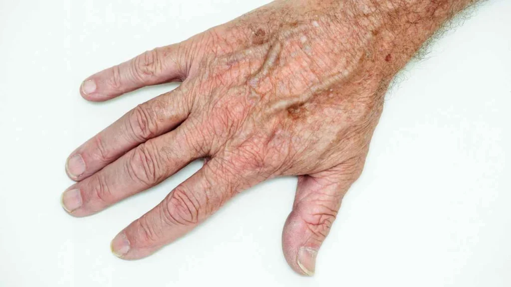 Male hand showing age spot Cottenham Park