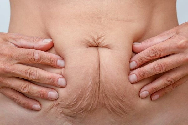 Image of a woman's stomach with loose skin - example of skin tightening Cottenham Park options