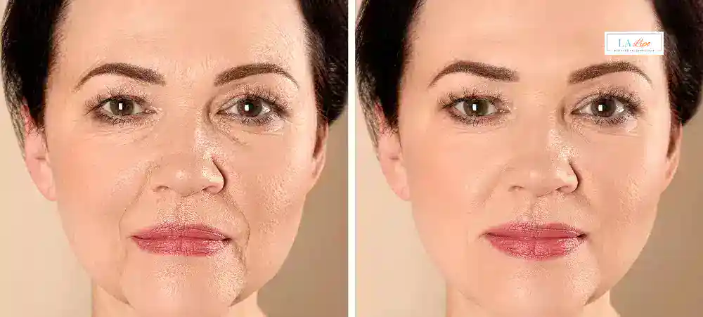 How Long Does It Take to See Results and How Long Do They Last Cottenham Park?