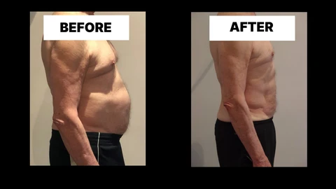 What Symptoms Can Diastasis Recti Cause in Men? Weak Core, Back Pain and Poor Posture Cottenham Park